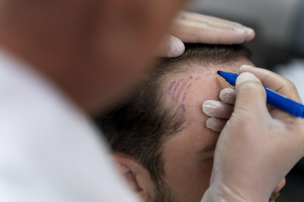 FUT hair transplant