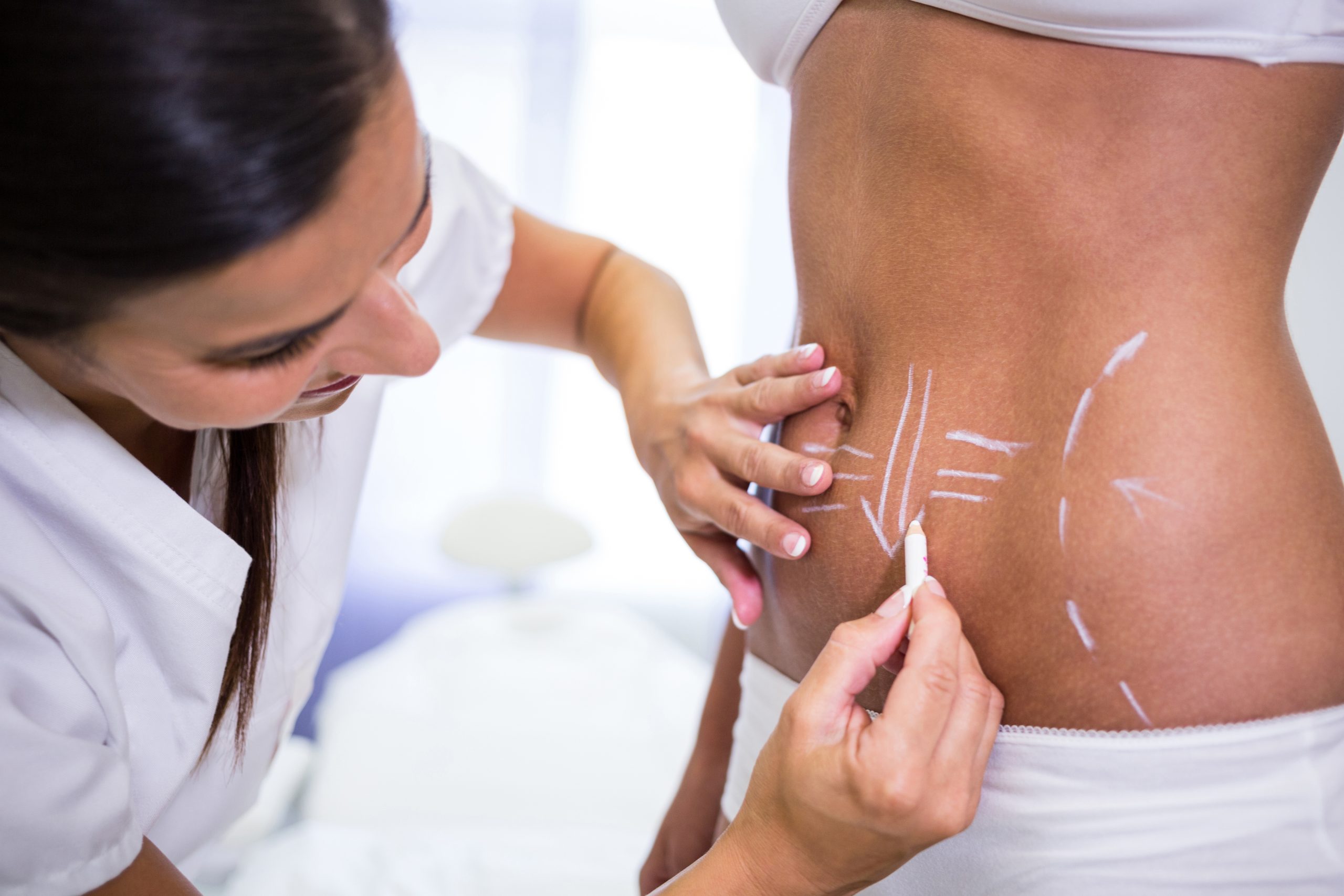 Tummy Tuck at jj asthetics
