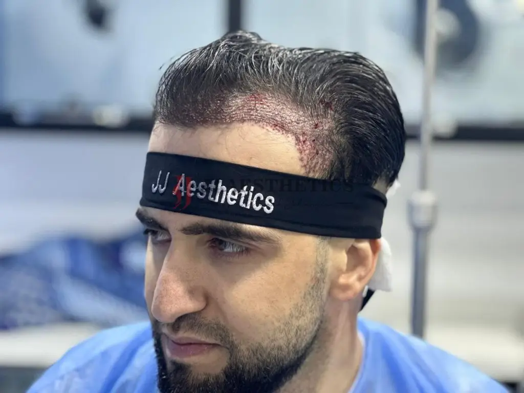 unshave fue hair transplant