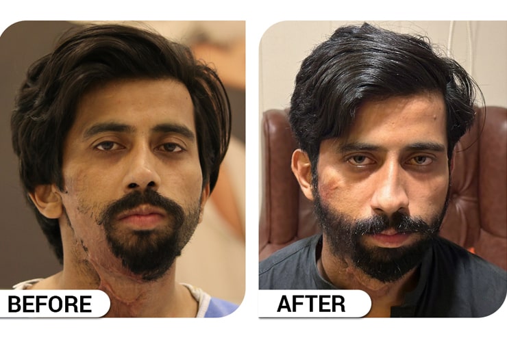 Beard Hair Transplant