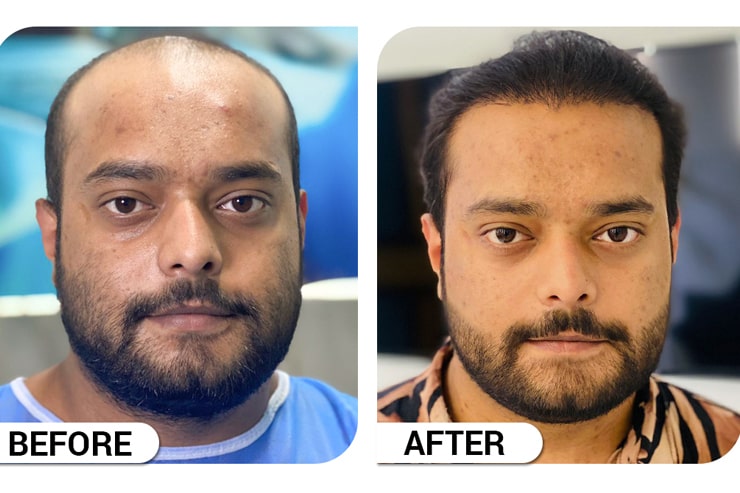 fue hair transplant