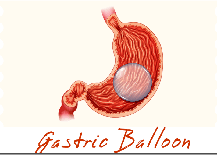 Gastric Balloon Weight loss Surgery in Islamabad