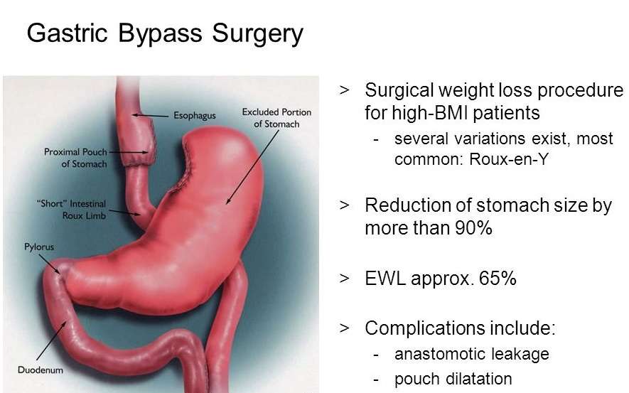 Gastric Bypass Surgery weight loss treatment in Islamabad