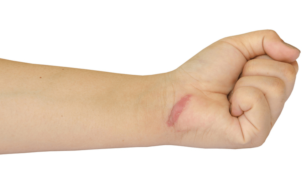 Keloid Removal Surgery in Islamabad