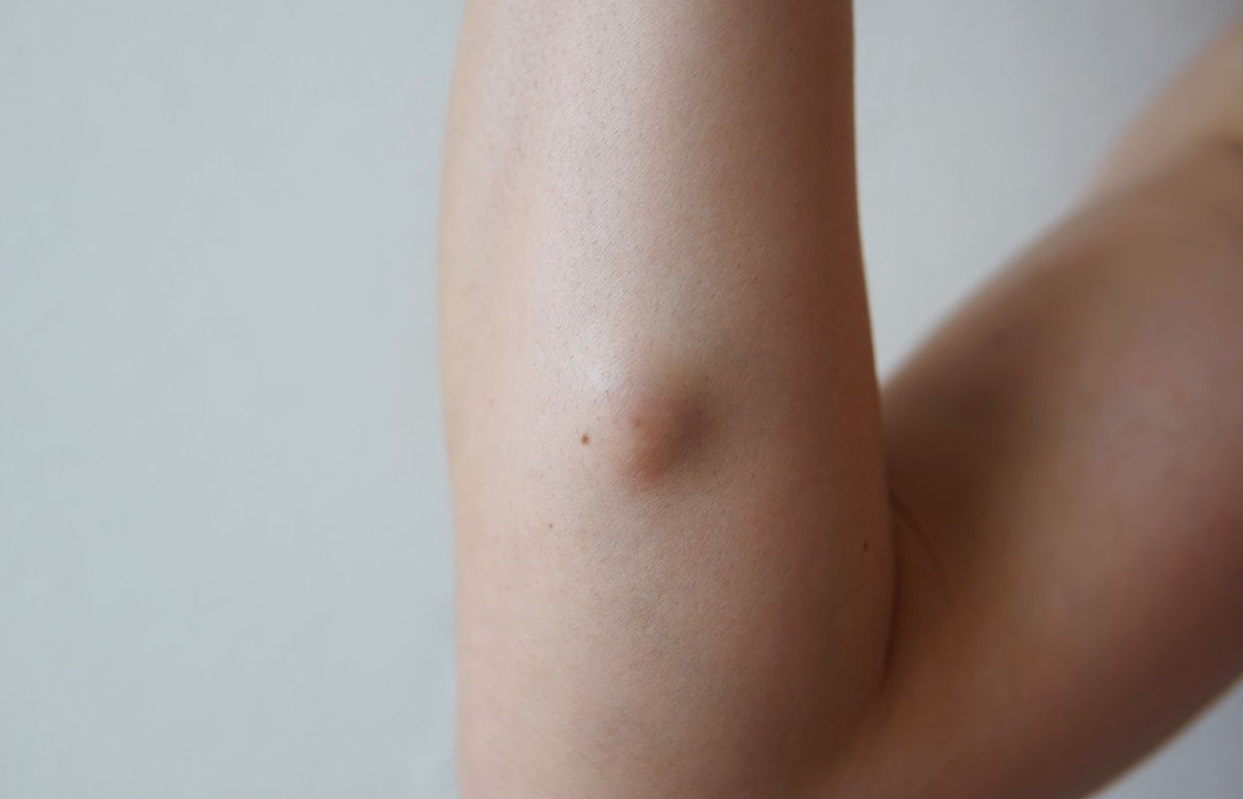 Lipoma Excision Treatment in Islamabad