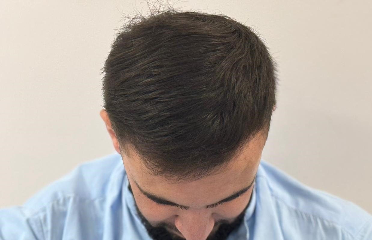 10,000 Grafts Hair Transplant Cost in Pakistan