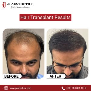 10,000 grafts hair transplant cost in Pakistan
