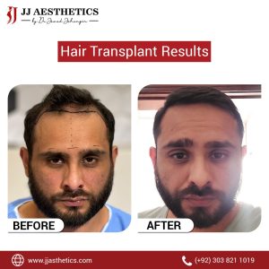 3000 grafts hair transplant cost in Pakistan