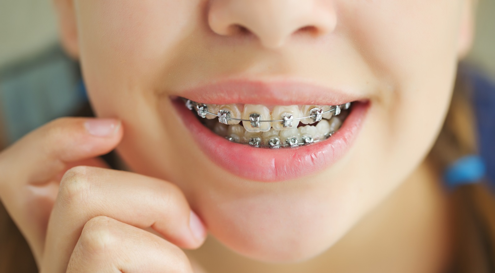 Dental Braces in Islamabad