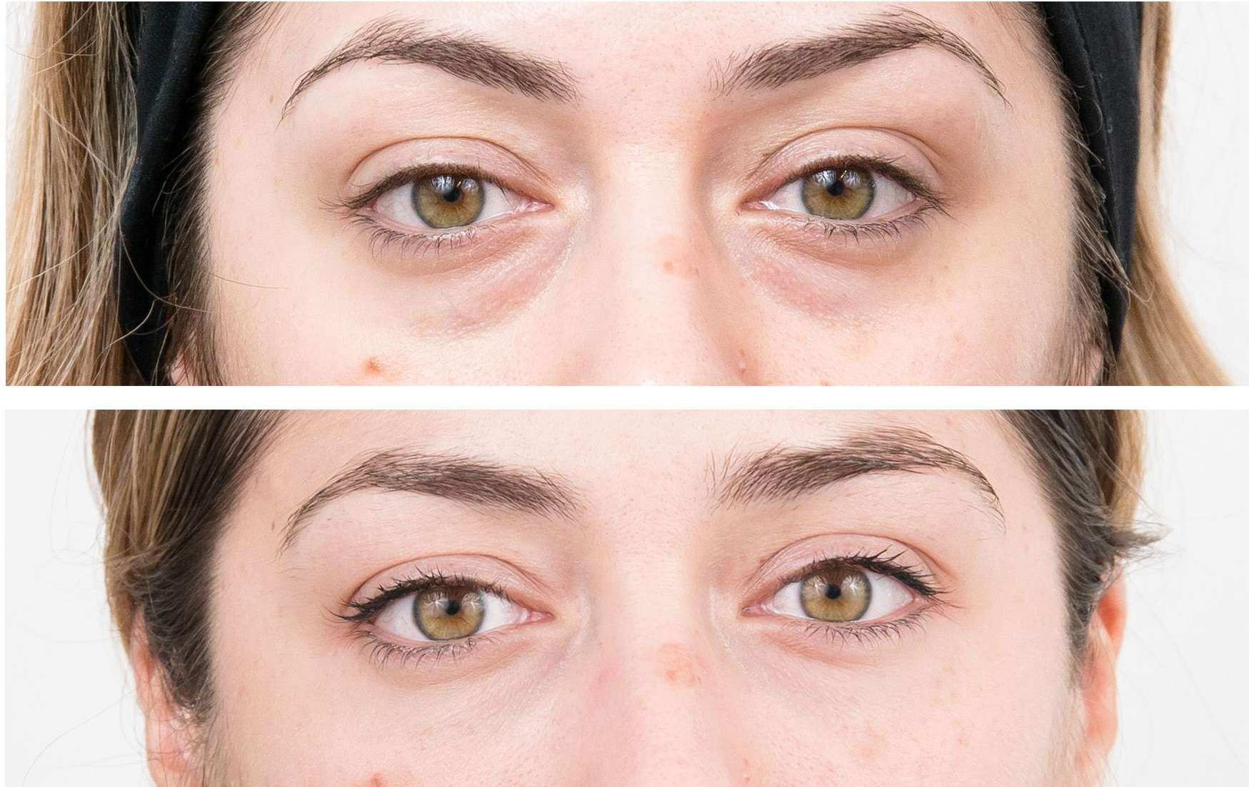 Eye Bag Removal in Islamabad Pakistan JJ Aesthetic Clinic