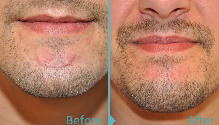 Facial Scar Revision Surgery in Islamabad