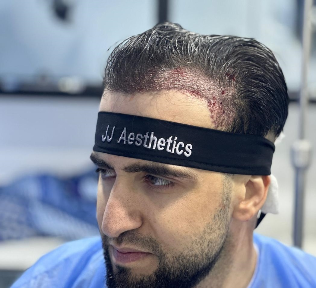 Hair transplant Before After Results Rawalpindi