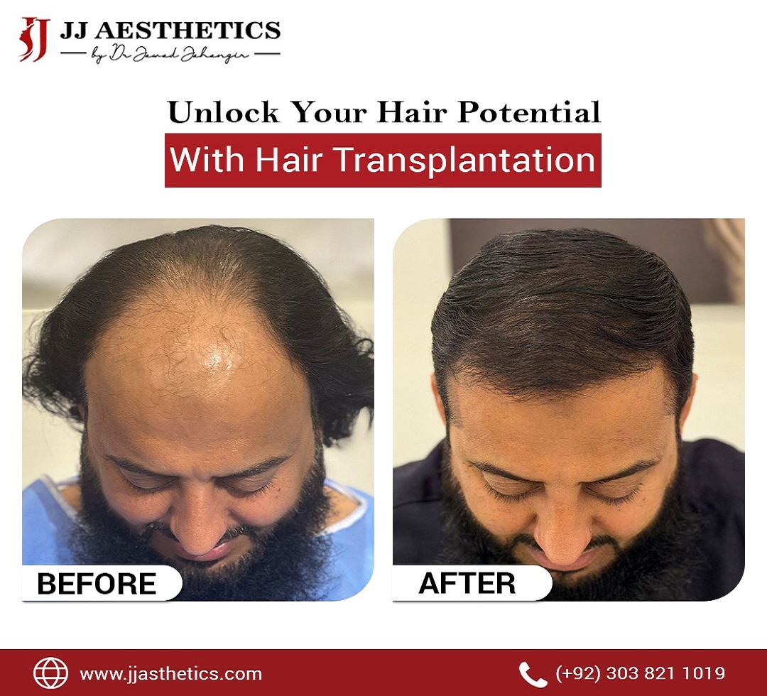 How Much Does 5000 Hair Grafts Cost in Pakistan