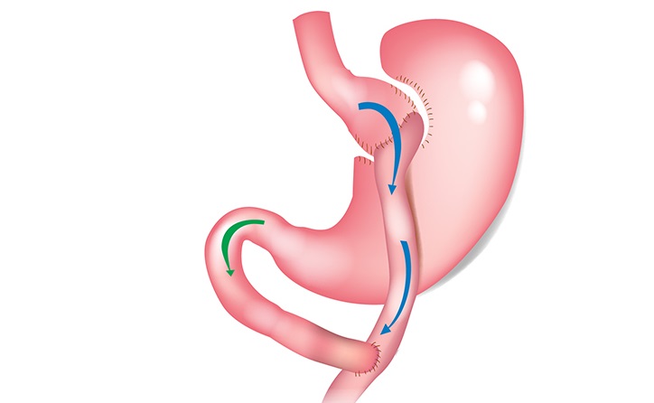 How Much Does Gastric Bypass Surgery Cost in Islamabad?