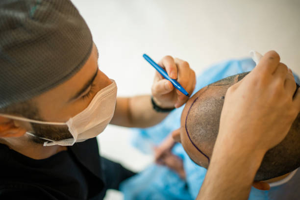How Much Does Hair Transplant Cost in Islamabad?