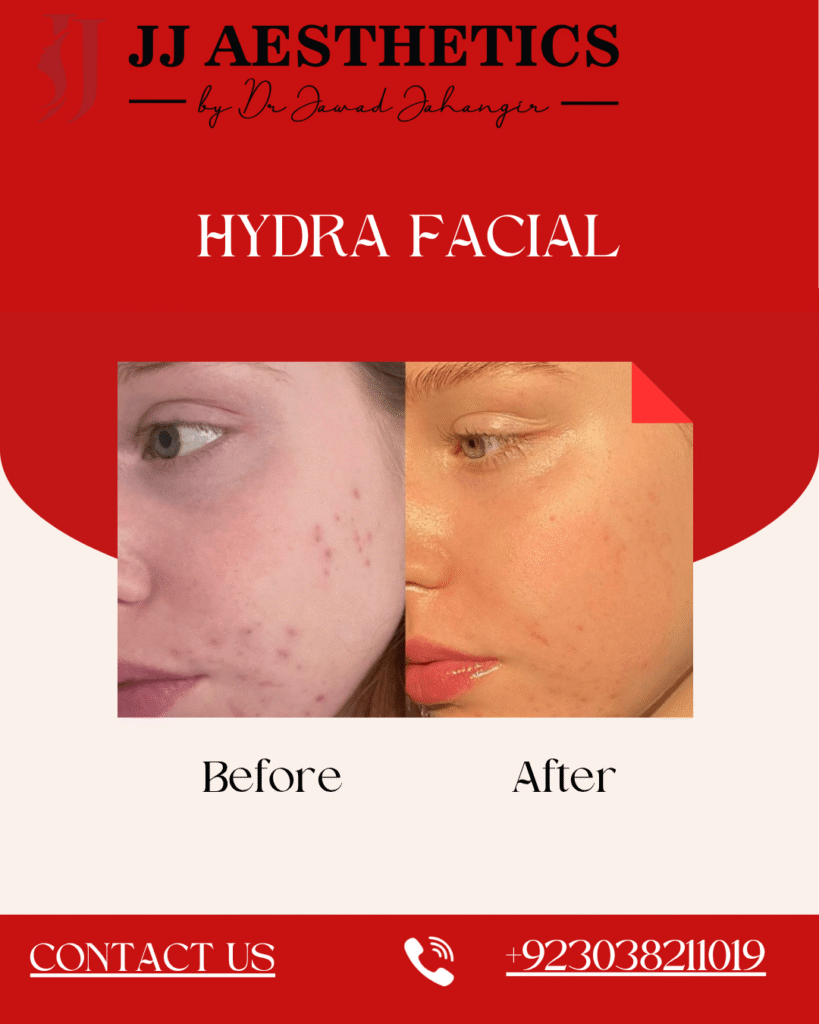 Hydrafacial in Rawalpindi Pakistan Cost