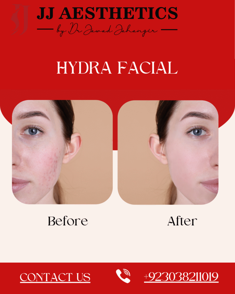 Hydrafacial in Rawalpindi Pakistan & Islamabad