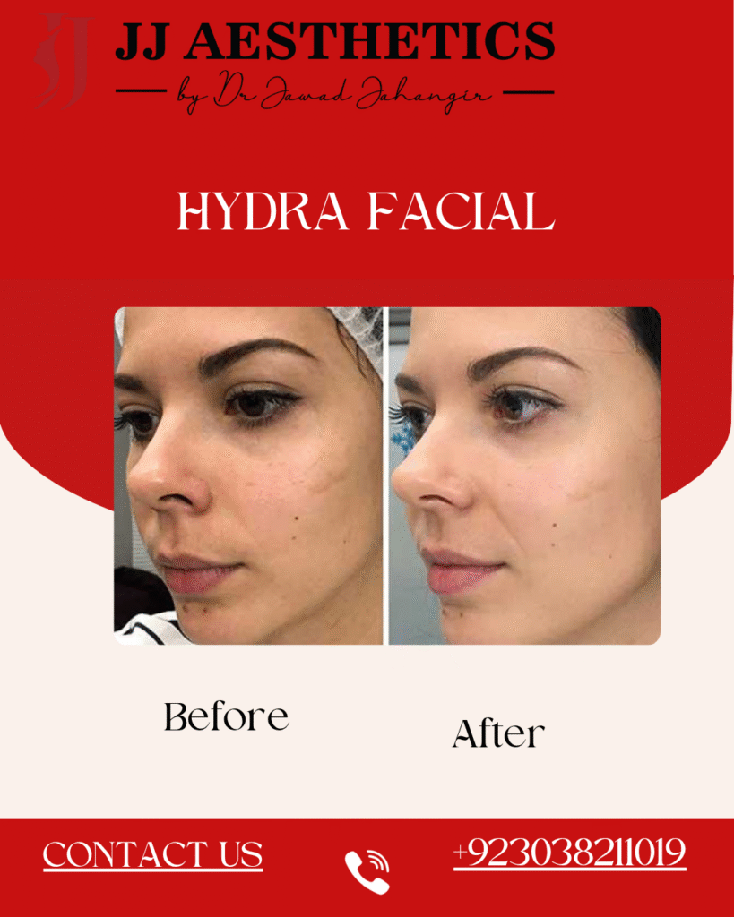 Hydrafacial in Rawalpindi Results