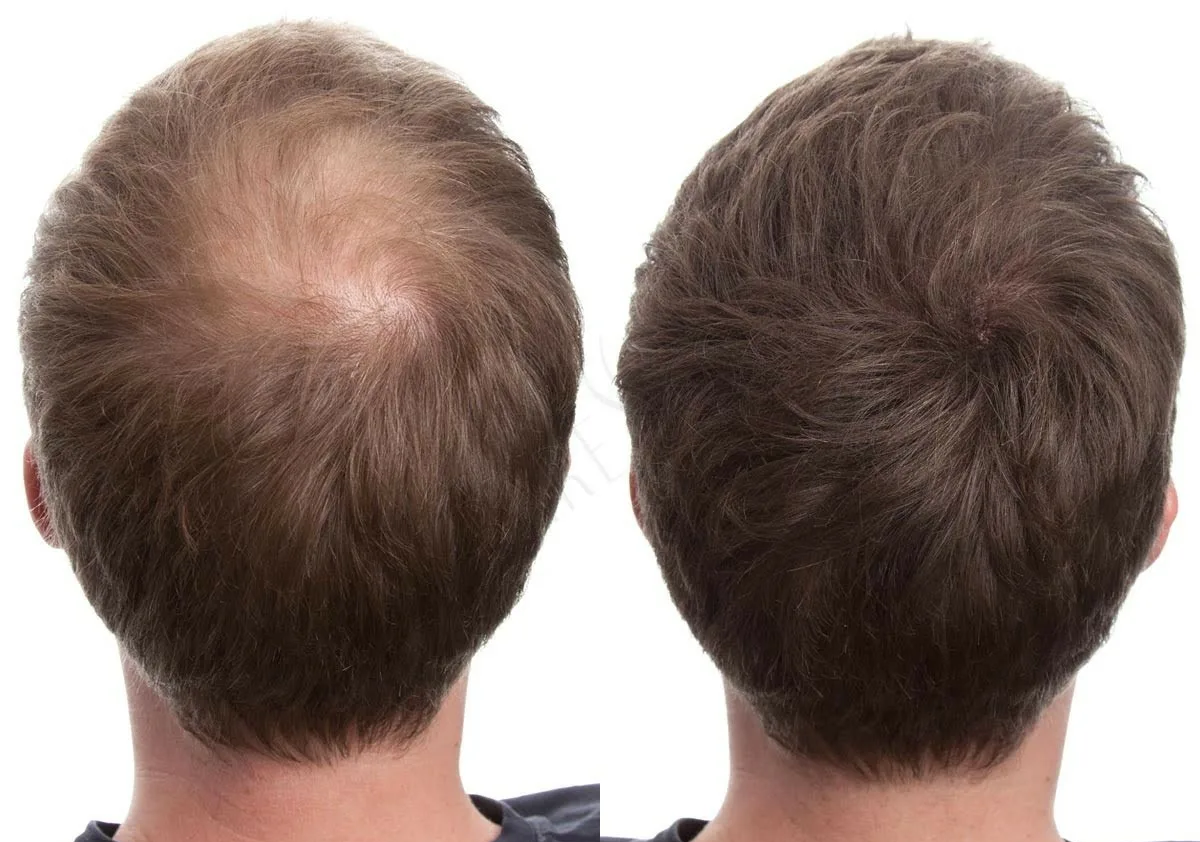 Price of Exosomes Hair Therapy in Pakistan