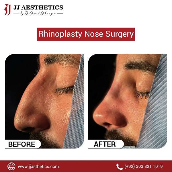Rhinoplasty Before after Results islamabad Clinic