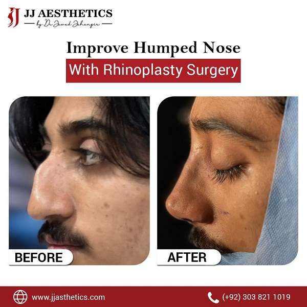 Rhinoplasty Cost and results Rawalpindi Clinic