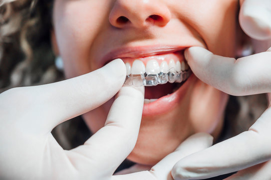 Teeth Aligners Cost in pakistan