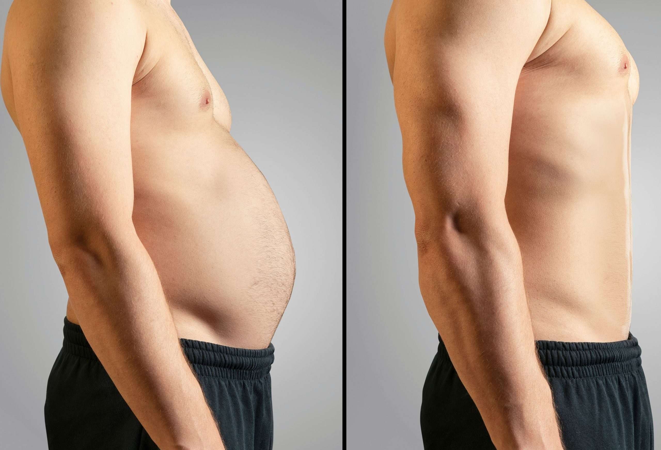 Tummy liposuction Cost in Pakistan