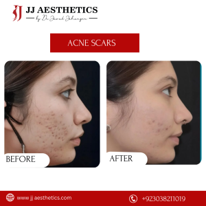 acen treatment price Islamabad