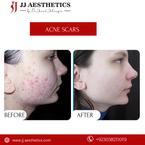 acen treatment price Islamabad