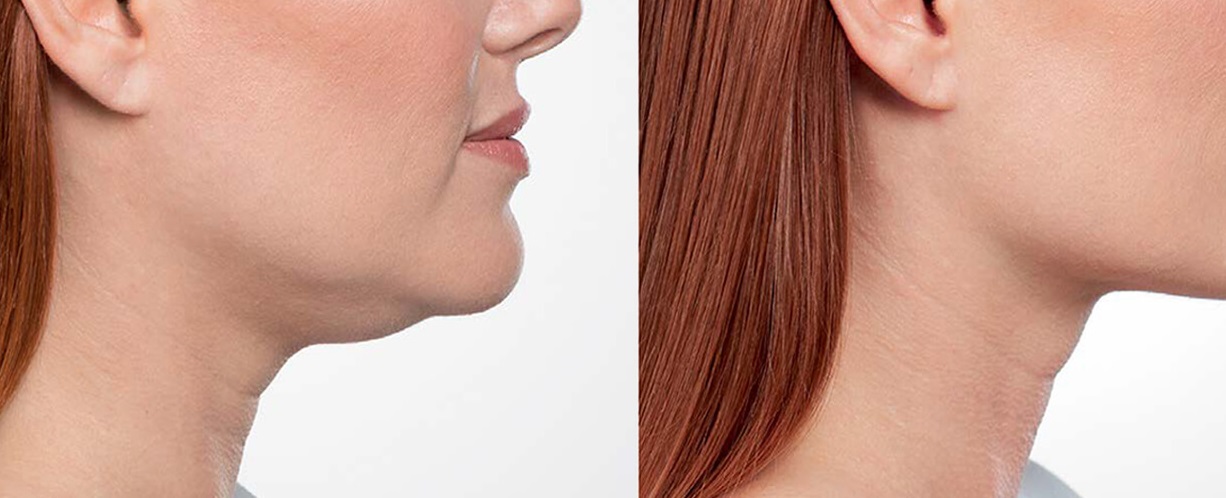 Buccal Fat Removal cost in Pakistan