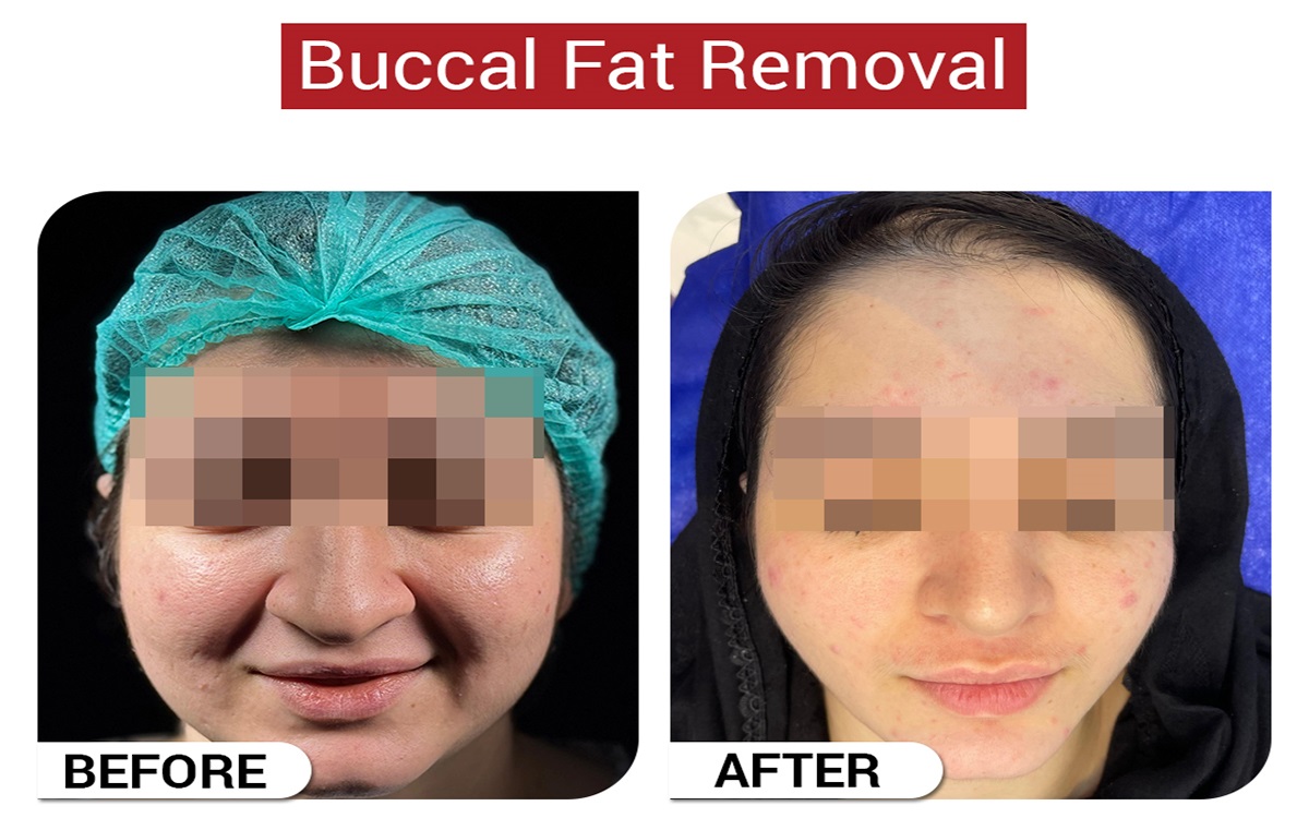 Buccal Fat Removal in Islamabad Pakistan