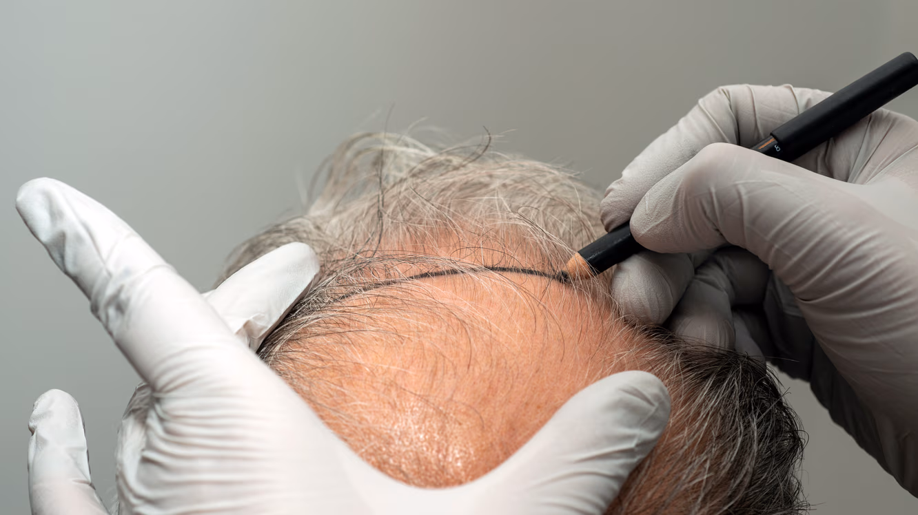 Can a fully bald person get a hair transplant