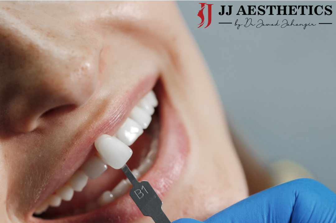 Dental Veneers in Islamabad