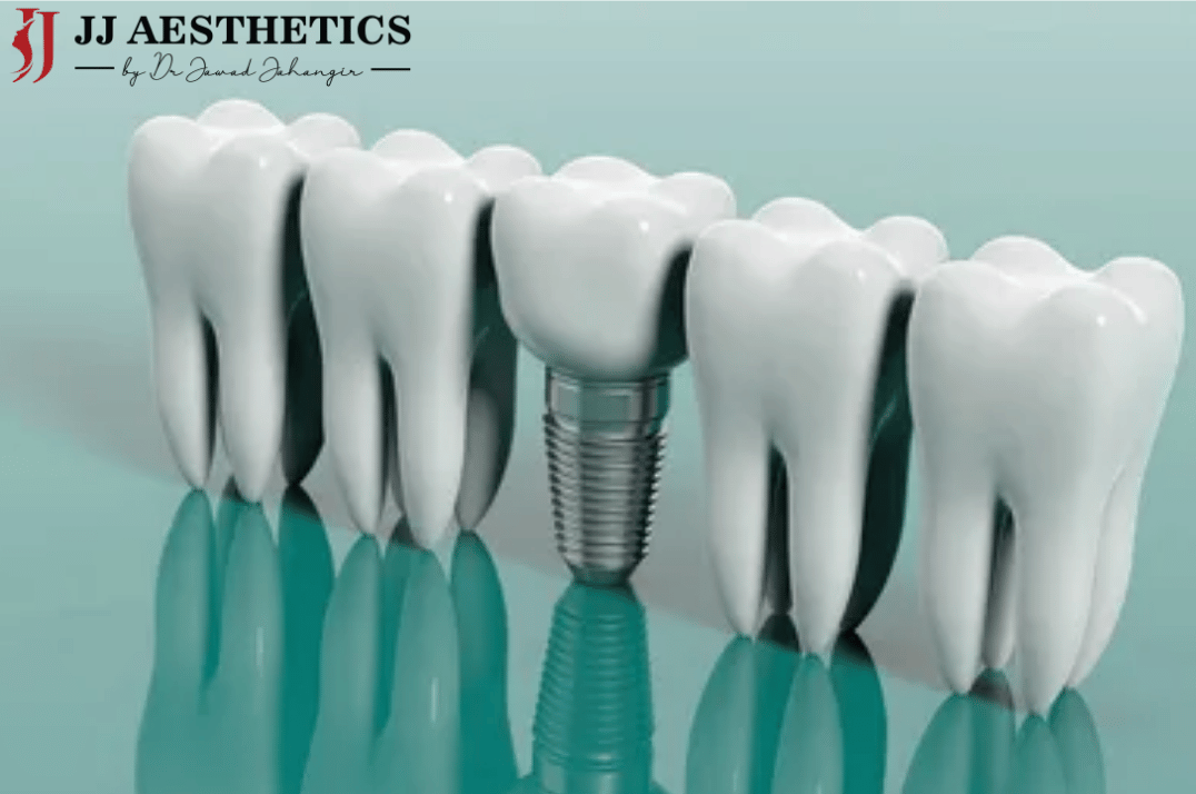 Dental implant in Islamabad