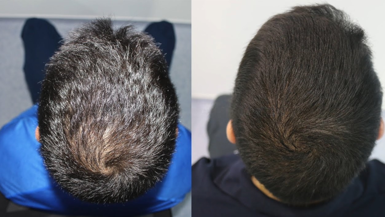 Does a crown hair transplant grow slower?