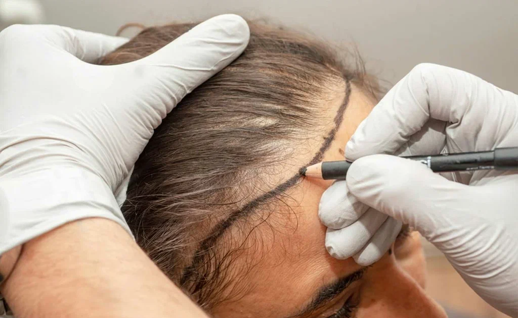 Female Hair Transplant in Islamabad