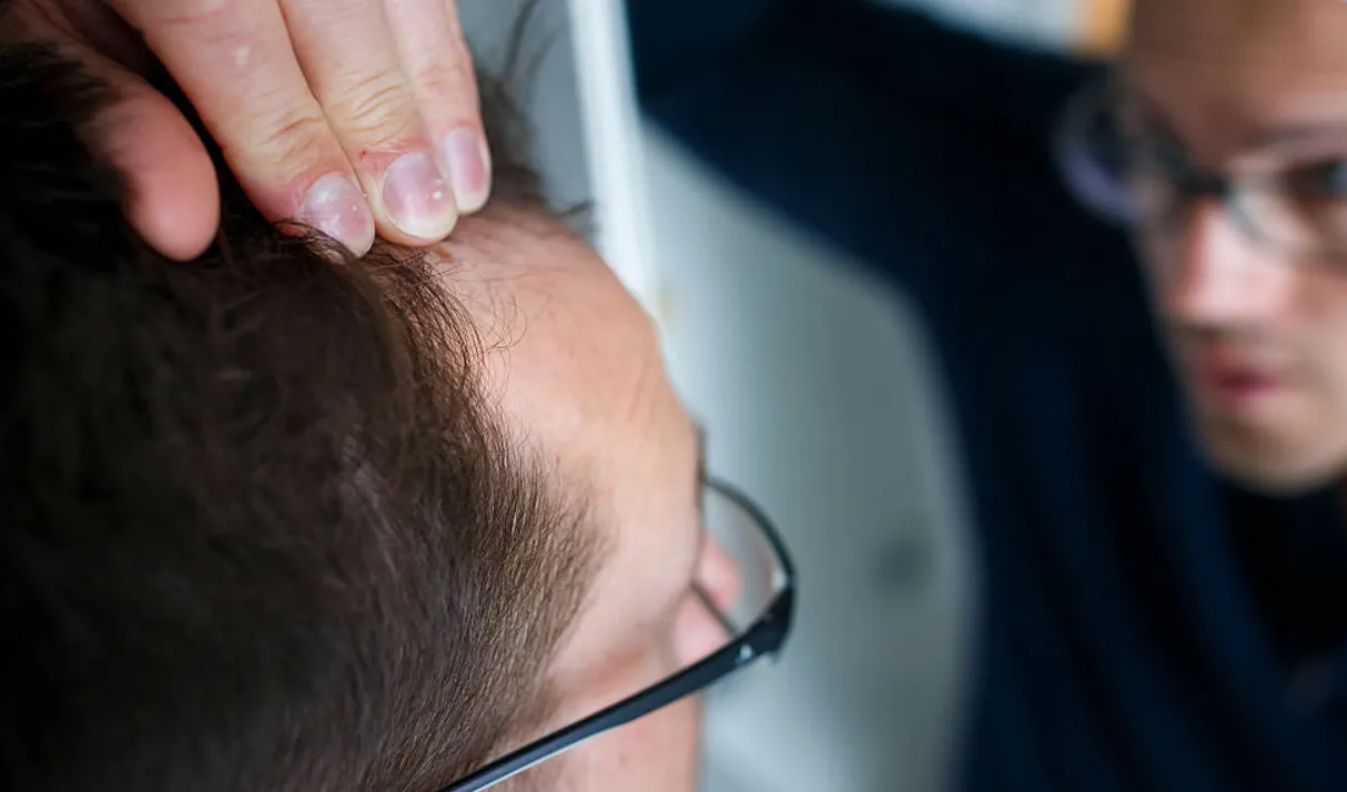 Hair Loss Treatment Price in Islamabad