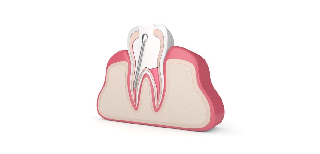How Long Can You Eat Normally After Getting a Root Canal
