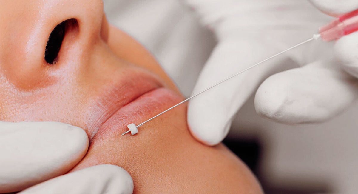 How Many Times Can You Have a Thread Lift on Your Face