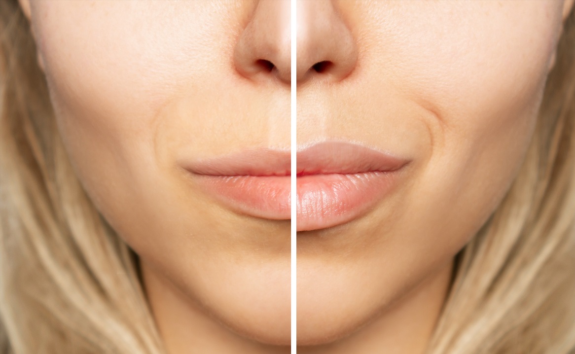 Lip Reduction Surgery in Islamabad