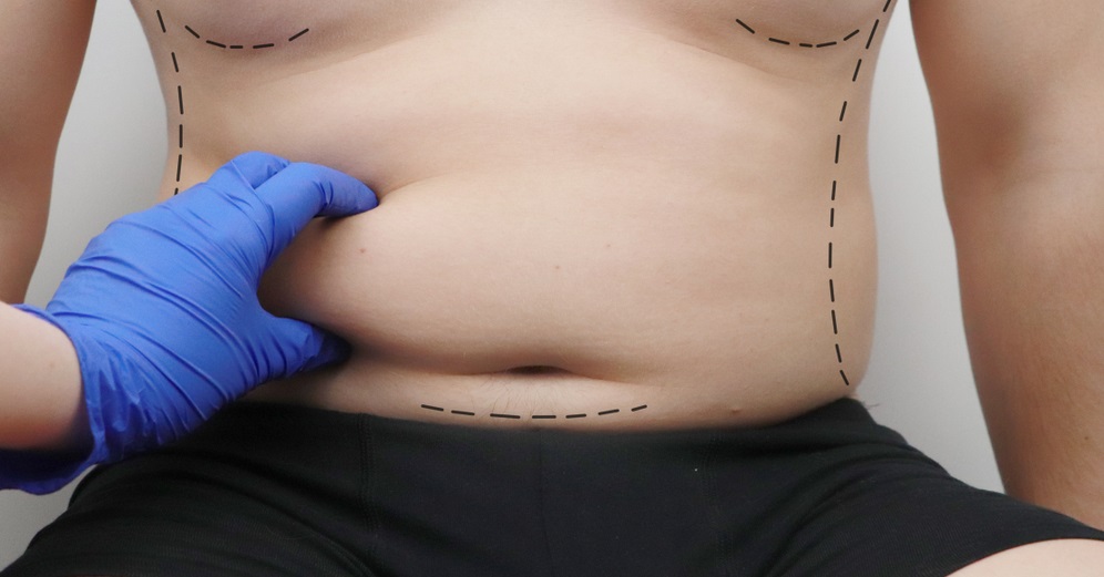 Non Surgical Fat Removal Treatment in Islamabad