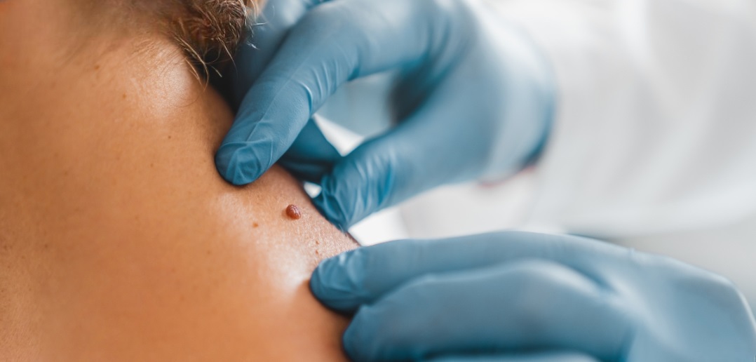 Skin Tag Removal in Islamabad Pakistan