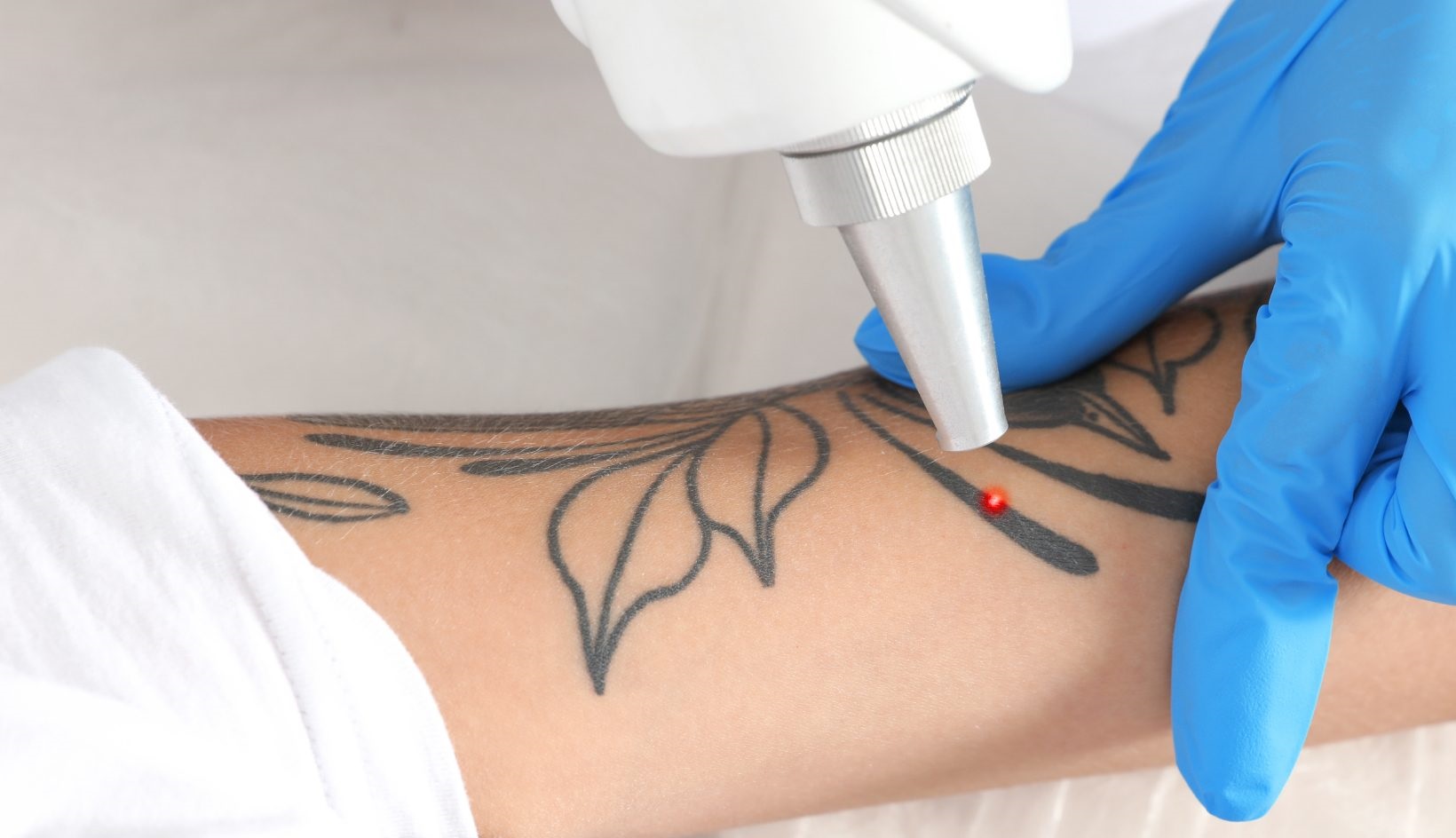 best Tattoo Removal in Islamabad