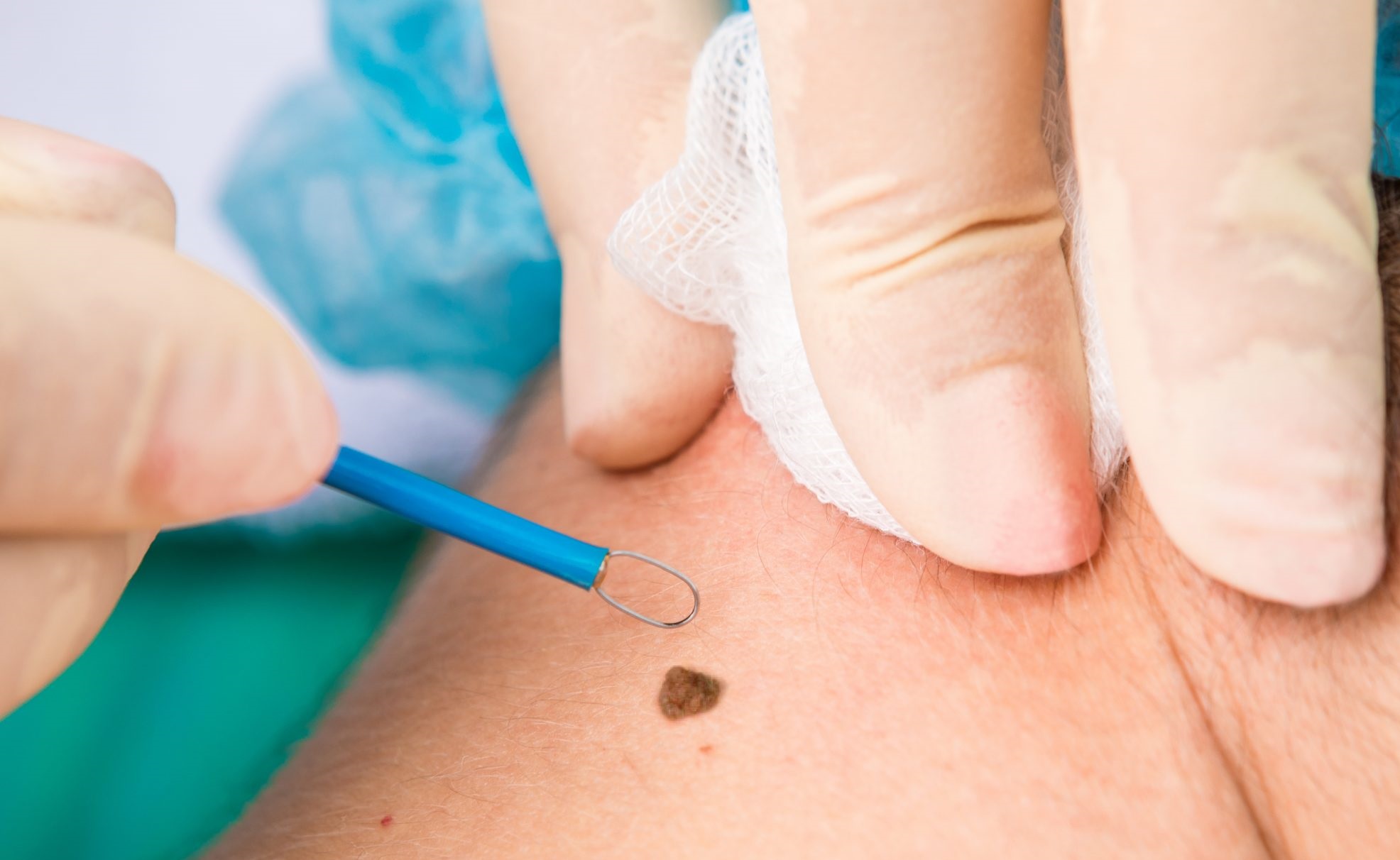 Mole Removal Cost in Islamabad