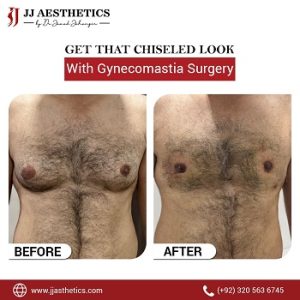 Gynecomastia Surgery Before After Islamabad