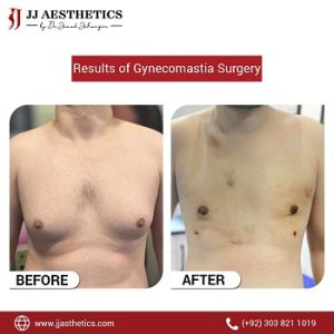 Gynecomastia Surgery Results in Islamabad