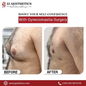 Gynecomastia Surgery pics Pakistan