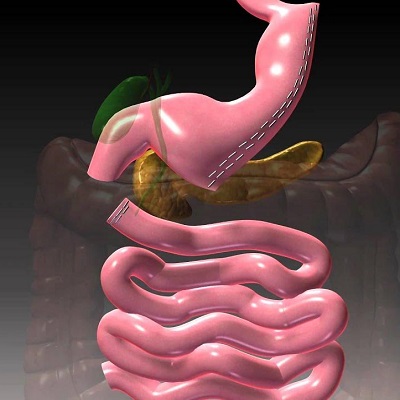 Duodenal Switch Surgery in Islamabad