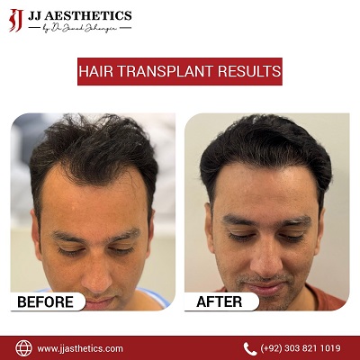 How Much Does 5000 Grafts Hair Transplant Cost in Pakistan?