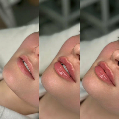 Lip Augmentation in Islamabad